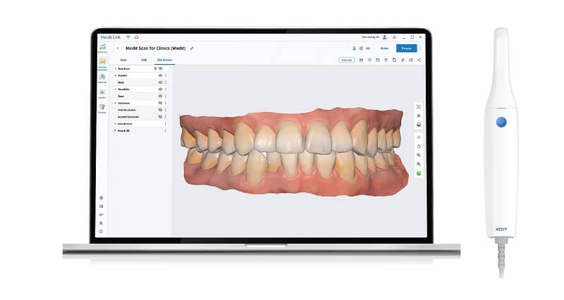 Scaner intraoral Mdit i500 - Hardware si software scanare 3D pentru clinica stomatologica