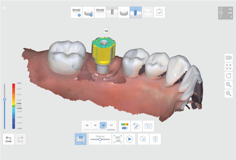 Scaner intraoral Mdit i500 -  scanare si identificare bonturi de implant si scan abutment