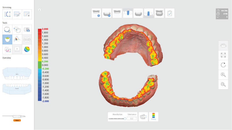 Scaner intraoral Mdit i500 - analiza digitala a ocluziei si a spatiului pentru coroane