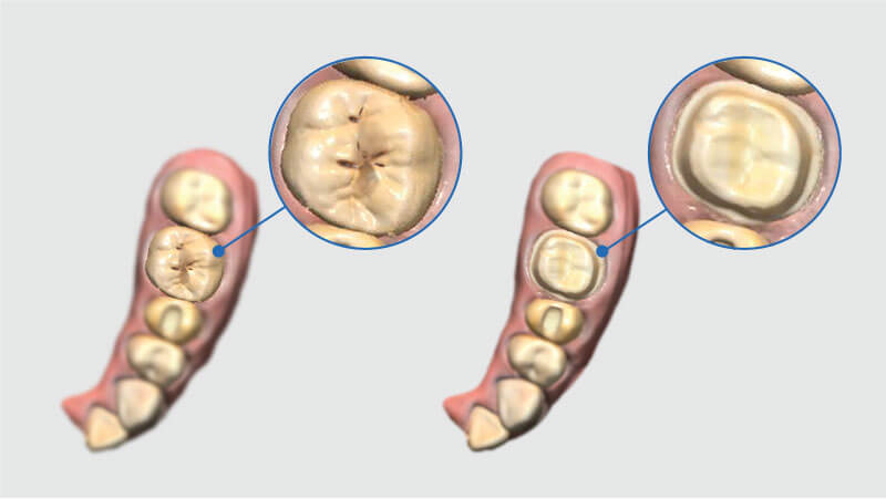 Scaner intraoral Mdit i500 - scanare preoperatorie