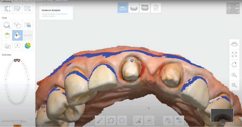 Scaner intraoral Mdit i500 - axul de insertie si analiza zonelor retentive