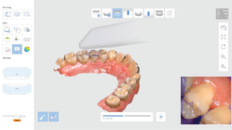 Scaner intraoral Mdit i500 - Replay scanare