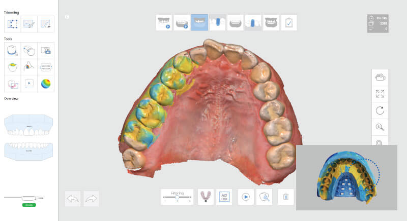 Scaner intraoral Mdit i500 - scanarea amprentei dentare