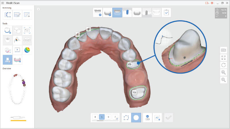 Scaner intraoral Mdit i500 - identificare linie marginala a preparatiei